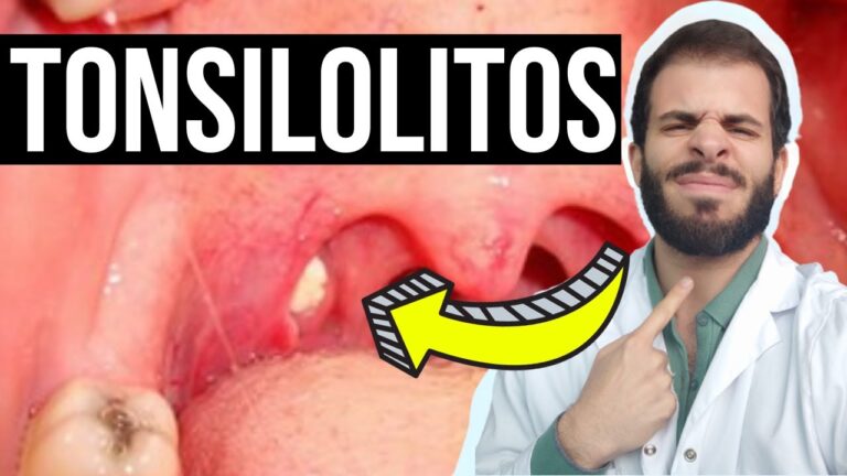 Remedios caseros para las bolitas blancas en la garganta