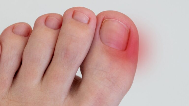 Ablandador de uñas enterradas casero: guía fácil y efectiva