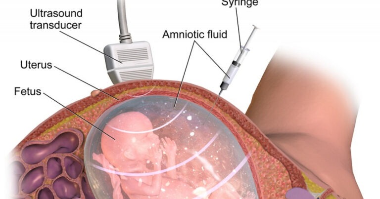 Amniocentesis: ¿Qué es y para qué sirve?