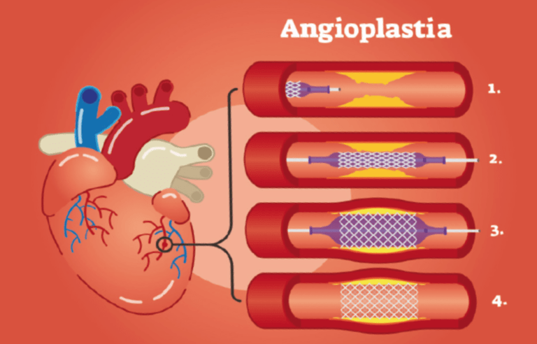 Angioplastia: ¿Qué es y cómo se realiza?