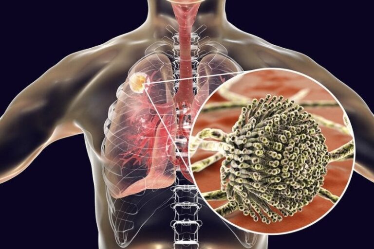 Aspergilosis: síntomas, causas y tratamientos esenciales