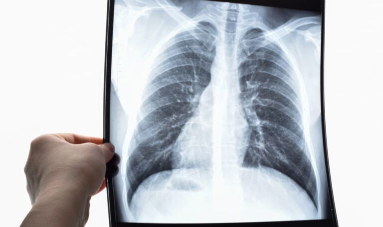 Atelectasia pulmonar: causas, síntomas y tratamientos