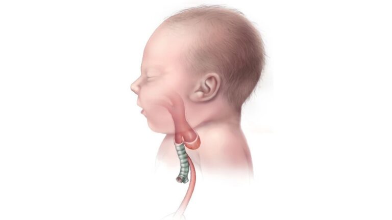 Atresia esofágica: implicaciones y salud infantil
