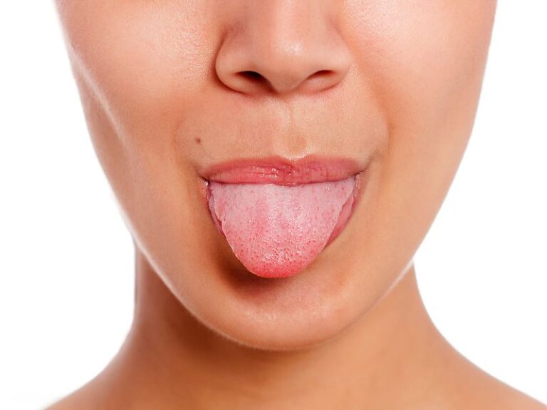 Candidiasis lengua: síntomas, causas y tratamientos efectivos