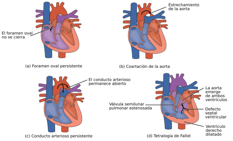 Cardiopatía congénita: síntomas y causas principales