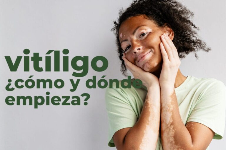 Causas del vitíligo: ¿Por qué aparece esta condición?