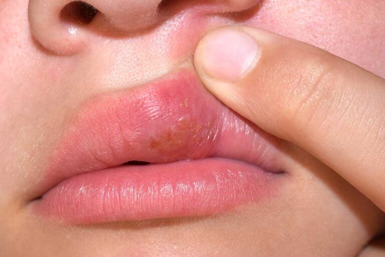 Como quitar una postemilla rápido: 11 consejos efectivos