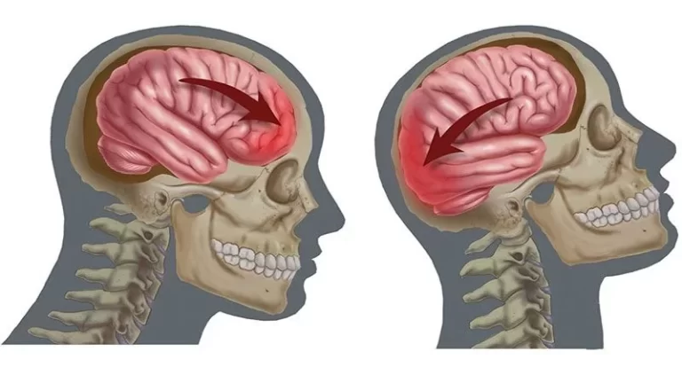 Contusiones cerebrales: síntomas y definición esencial