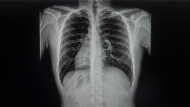 Dextrocardia: síntomas y tratamientos disponibles