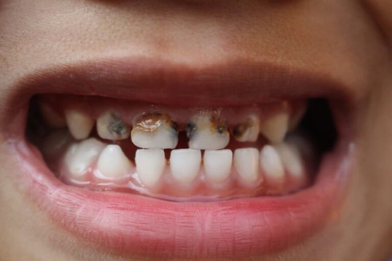 Dientes con caries: causas y tratamientos efectivos