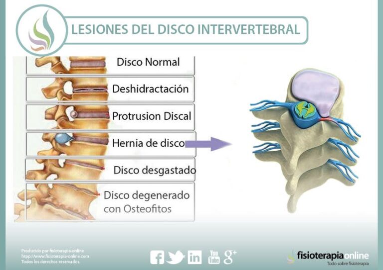Discos intervertebrales: funciones y anatomía explicadas