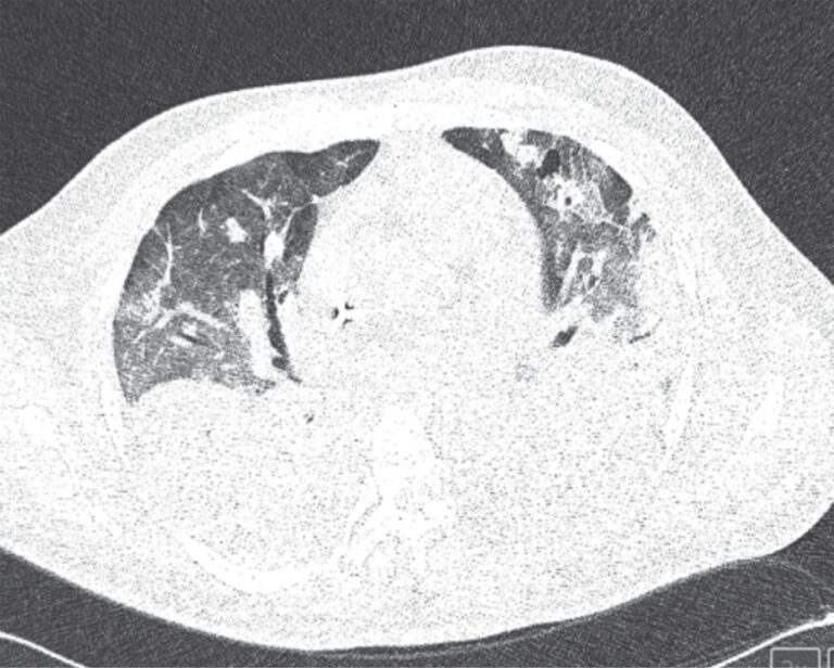 Enfisema subcutáneo: causas, síntomas y tratamientos efectivos