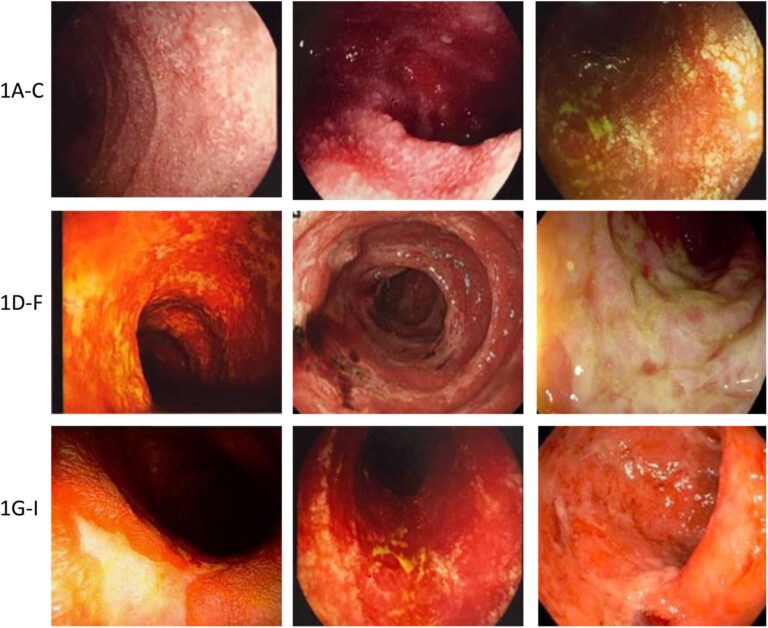 Enterocolitis: síntomas, diagnóstico y tratamiento explicados
