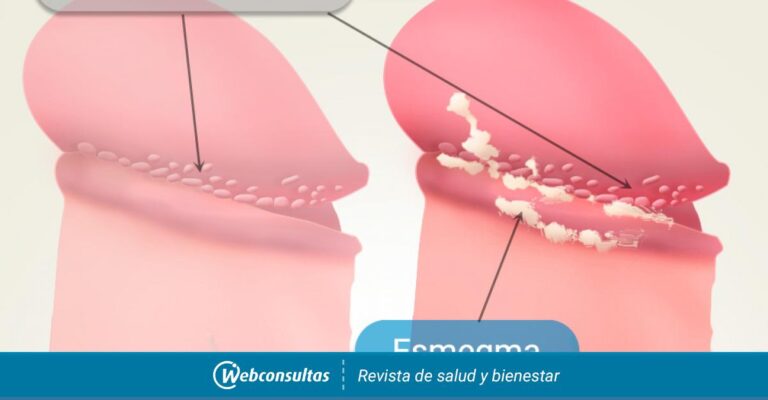 Esmegma femenino: causas, tratamiento y qué es