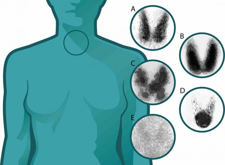 Gammagrama tiroideo: ¿qué es y para qué se utiliza?