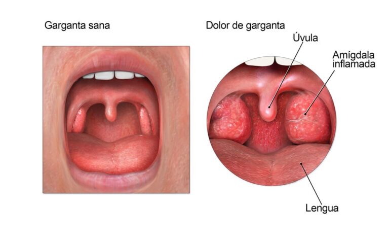 Garganta con infección viral: síntomas y tratamiento eficaz
