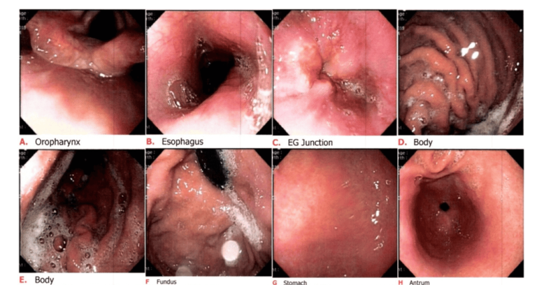 Gastritis emocional: síntomas, causas y tratamientos efectivos