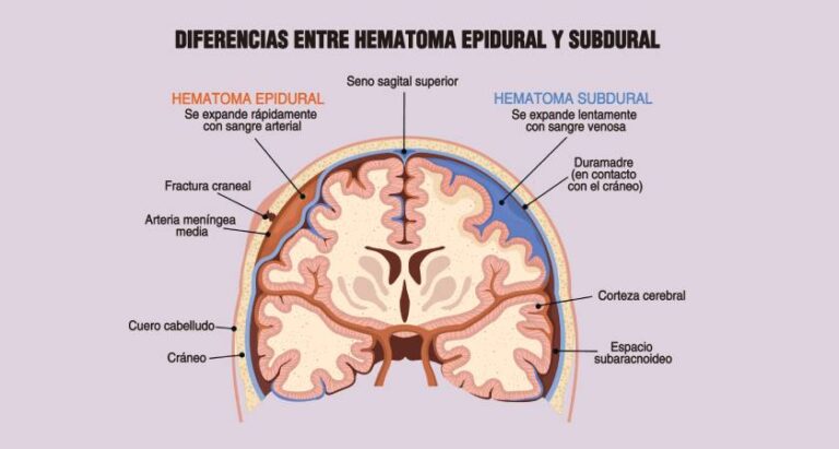 Hematoma subdural agudo: síntomas y causas principales