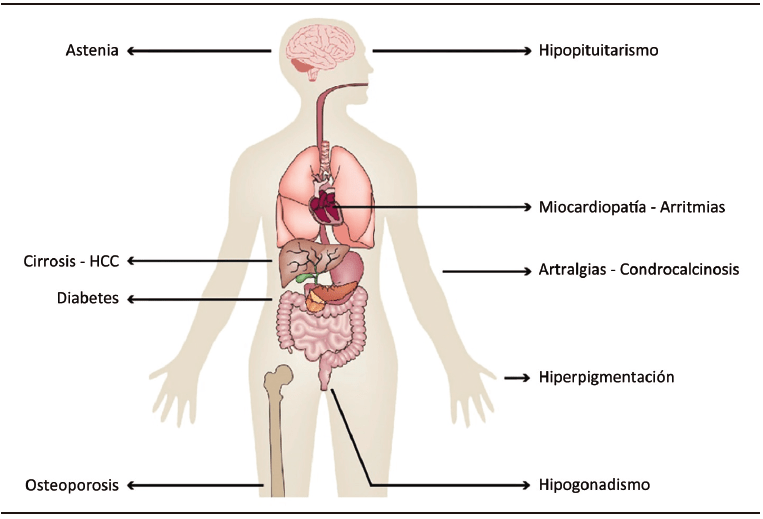Hemocromatosis: síntomas, causas y diagnóstico esencial