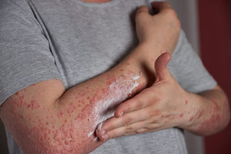 Herpes zóster es contagioso: ¿Qué debes saber?