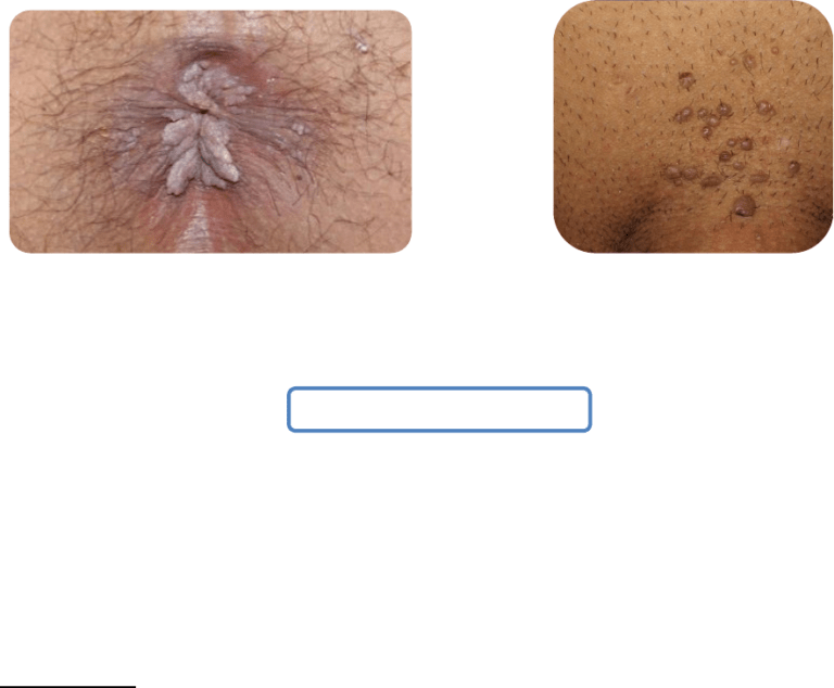Linfogranuloma venéreo: síntomas y causas explicadas