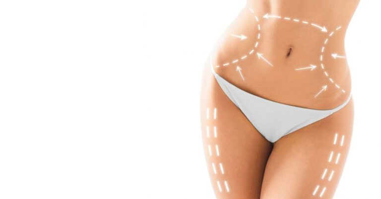 Lipocavitación: ¿Qué es y cuáles son sus beneficios?