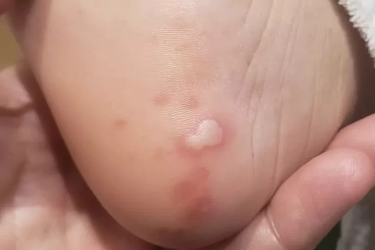 Livedo reticularis: causas y síntomas explicados