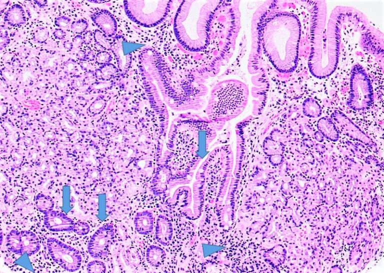 Metaplasia intestinal síntomas: descubre sus señales clave
