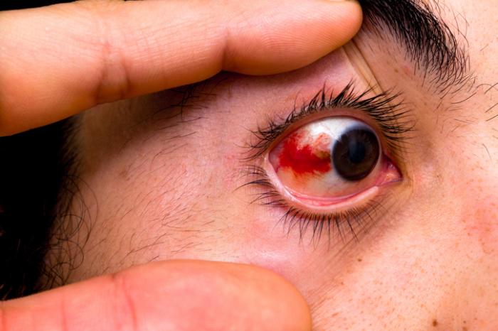 Ojo irritado: causas y tratamientos efectivos