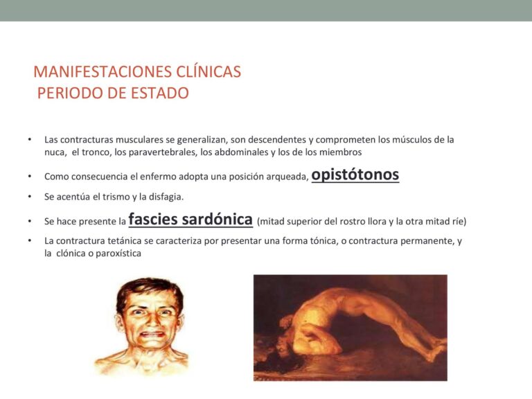 Opistotonos: Definición y características clínicas