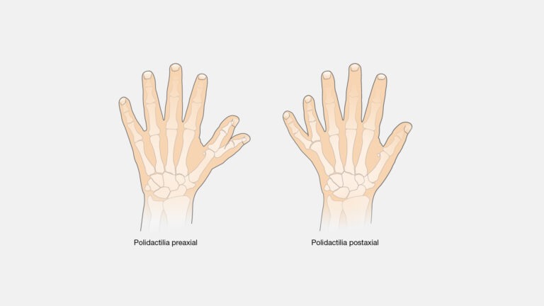 Polidactilia: ¿Qué es y cómo afecta a las personas?