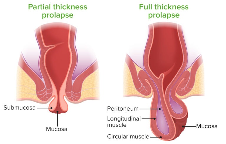 Prolapso anal: síntomas, causas y tratamientos efectivos