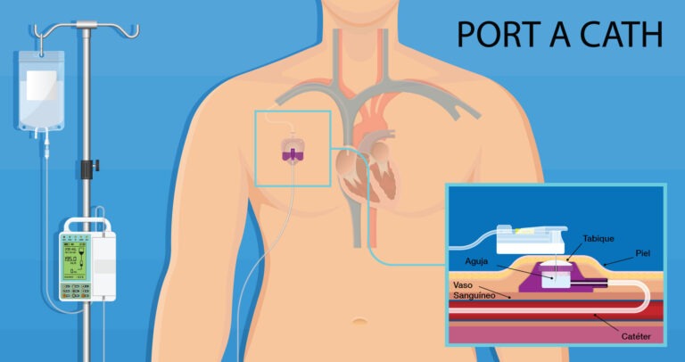 Puerto catéter: ¿Qué es y cómo se utiliza?
