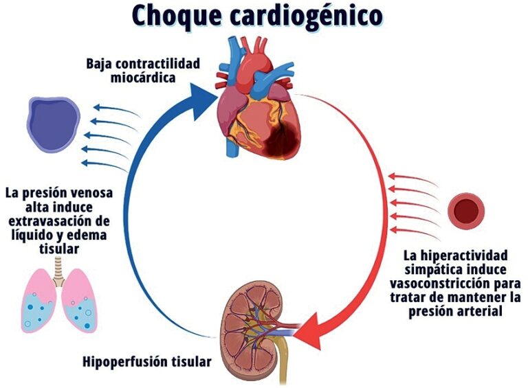 Shock cardiogénico: Definición y causas principales