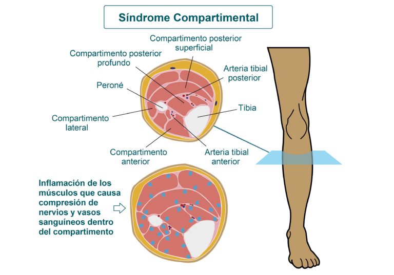 Síndrome compartimental: causas y síntomas explicados