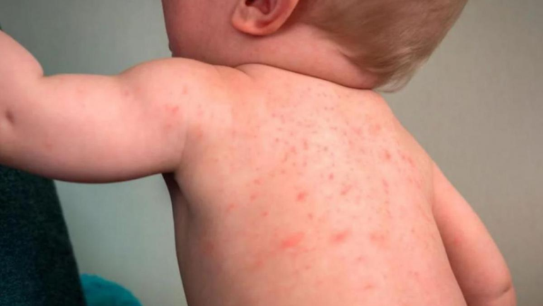 Síntomas del dengue en bebés de 1 año: Guía esencial