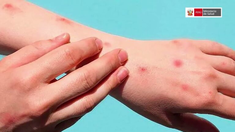 Síntomas viruela del mono: ¿Cuáles son y cómo identificarlos?