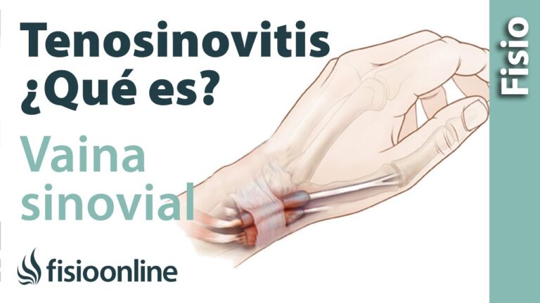 Tenosinovitis: síntomas, causas y tratamientos explicados