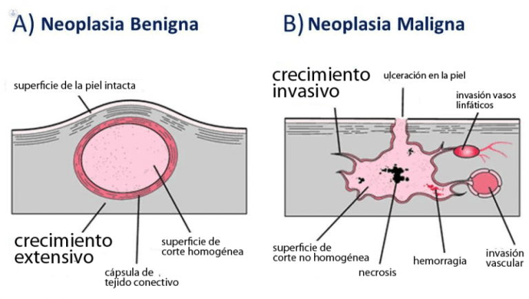 Tumor benigno: Definición y características esenciales