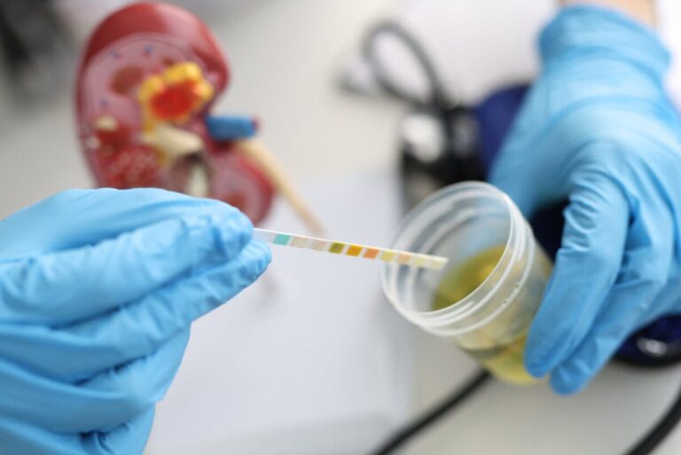 Urobilinógeno: Importancia en la prueba de orina
